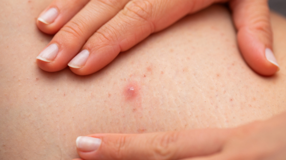 Hårsäcksinflammation (follikulit): symtom, orsaker & behandling